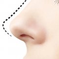Botox - zwężenie nosa i uniesienie koniuszka nosa